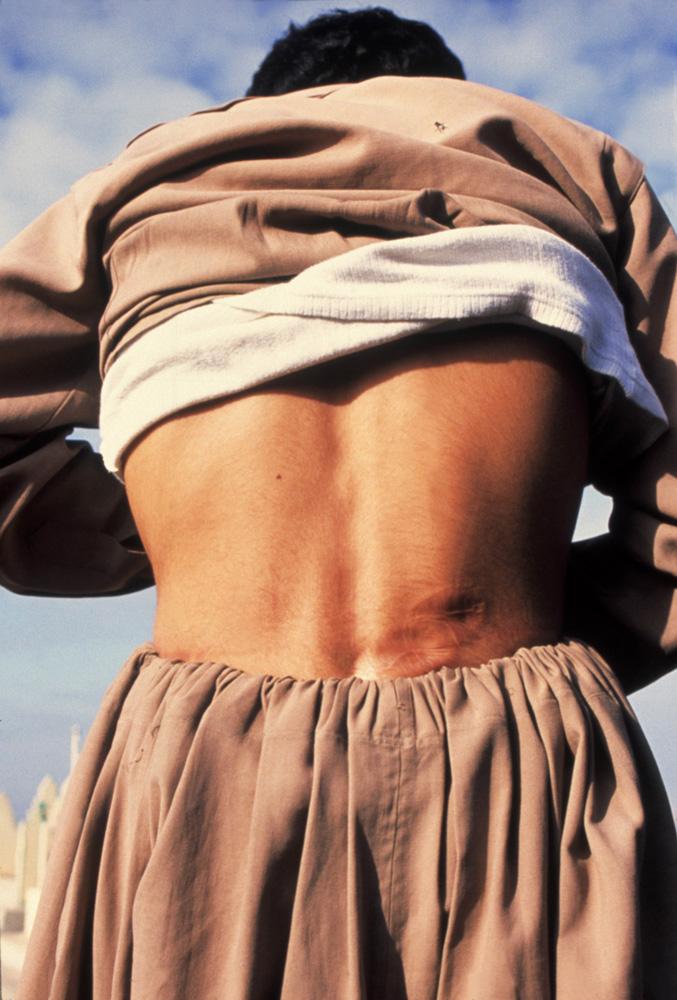 A man showing a bullet hole in his lower back. 